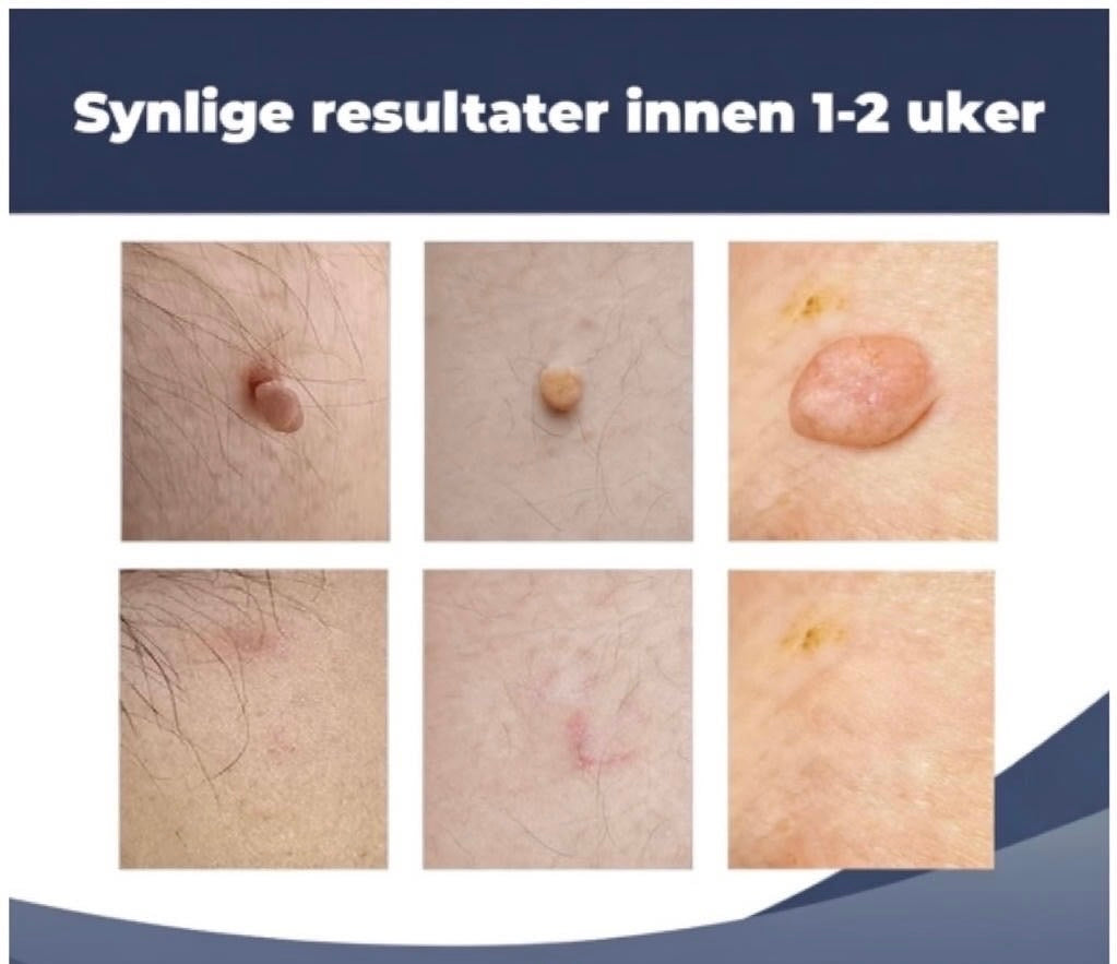 Hudflikfjerner - Slutt å skamme deg over hudflikene dine